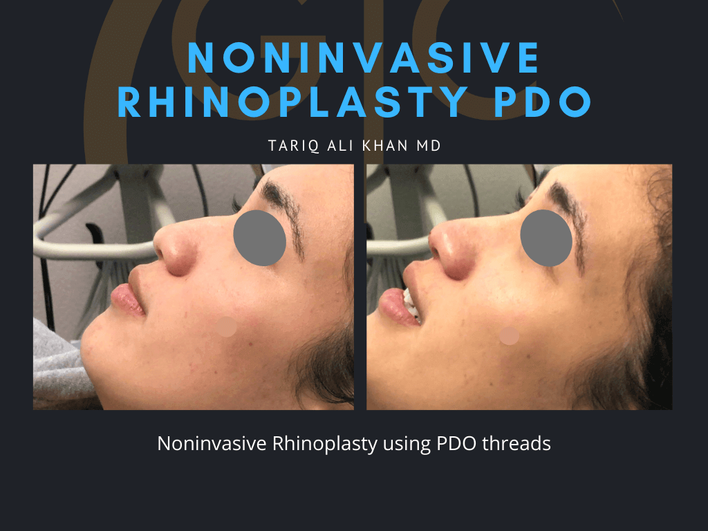 Gentle Care Laser Tustin Before and After picture - PDO Rhinoplasty